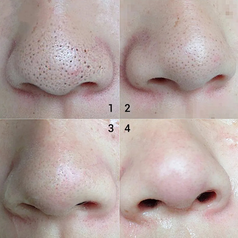 BREYLEE Blackhead Shrinking Kit – Deep Cleanse & Pore Tightening Solution