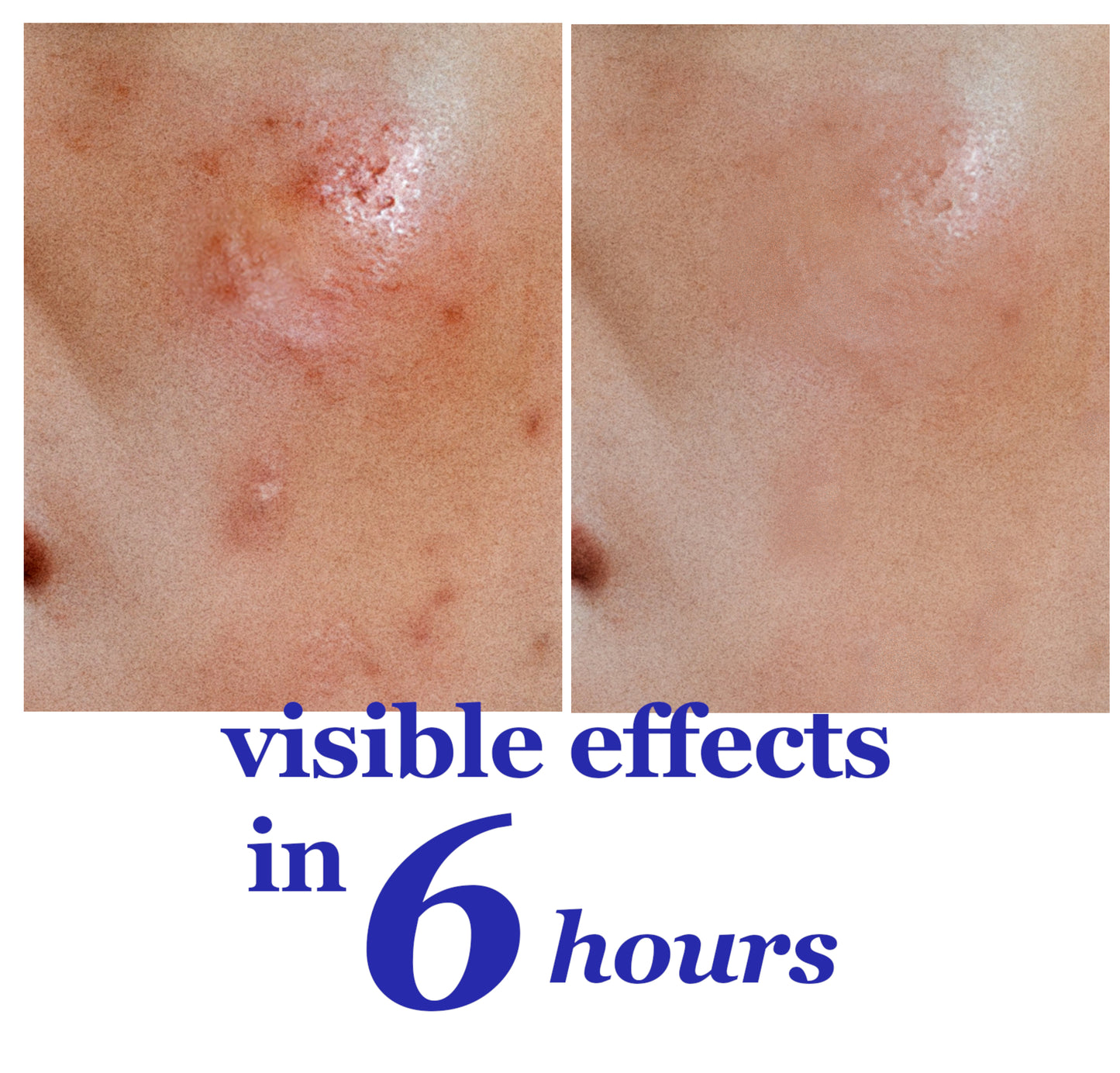 Acne Relief Patch – Gentle Tea Tree & Calendula Spot Treatment (132 Patches)