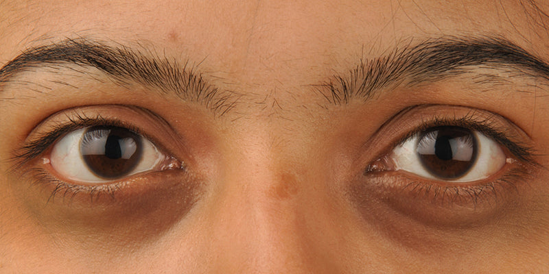 How to Get Rid of Dark Circles: Real Reasons, Real Fixes, and Smart Eye Cream Picks