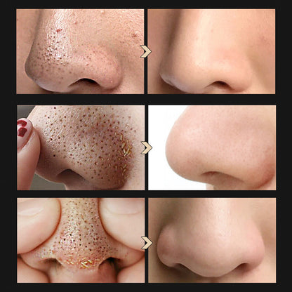 BREYLEE Blackhead Removal Kit