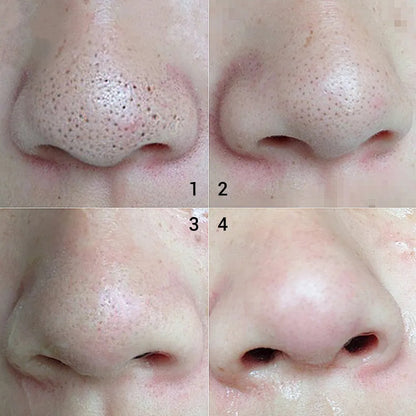 BREYLEE Blackhead Removal Kit